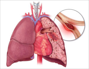 Эмболия легочной артерии