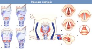 Травмы  гортани и трахеи