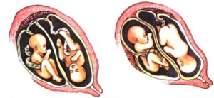 Mногоплодная беременность: Двойнята и больше детей