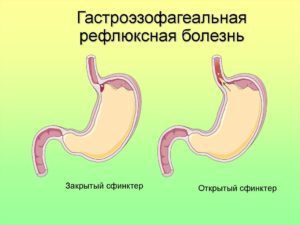 Изжога и гастроэзофагеальная рефлюксная болезнь (ГЭРБ)