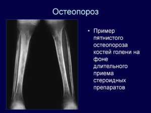 Пятнистый посттравматический остеопороз и другие осложнения