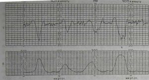 Интранатальная кардиотокография