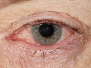 Как предотвратить синдром сухого глаза?