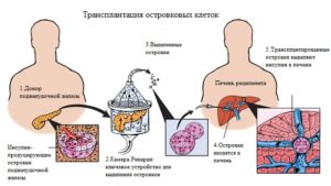 Трансплантация островковых клеток в качестве одного из способов лечения сахарного диабета