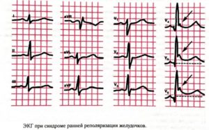 Симптомы болезни - нарушенияпроцессов реполяризации желудочков