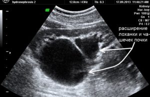 Гидрокаликоз правой почки у беременной 25 неделя беременности