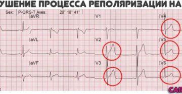 Симптомы болезни - нарушения реполяризации желудочков