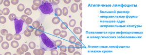Атипичные формы лимфоцитов у ребенка