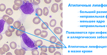 Атипичные формы лимфоцитов у ребенка