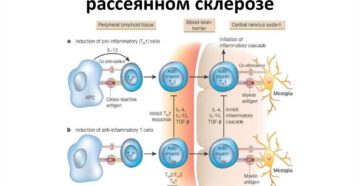 Рассеянный склероз: коррекция тремора при рассеянном склерозе