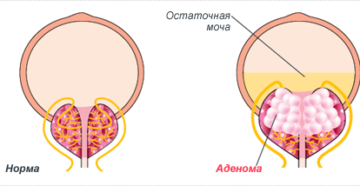 остаточная моча, холодный половой член