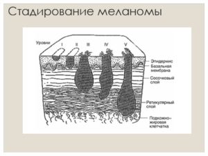 Система стадирования меланомы