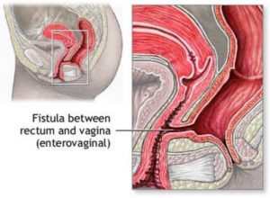 ректо-вагинальный свищ