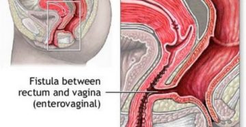 ректо-вагинальный свищ