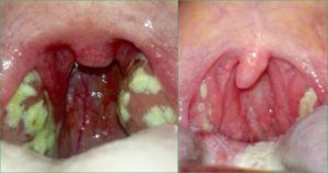 Кость или рана в горле