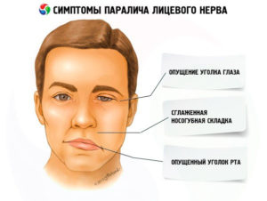 Отогенное воспаление и травма лицевого нерва