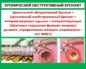Бронхит хронический обструктивный