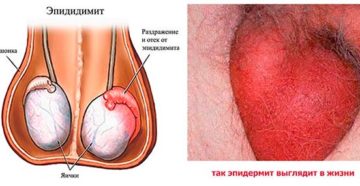 Застудил пах(яички)