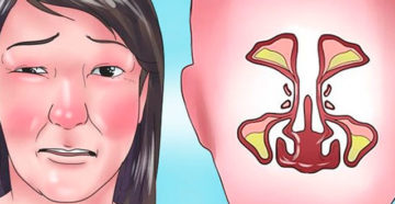 Онемение части лица после гайморита