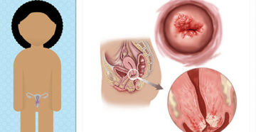 Вирус герпеса и его связь с раком шейки матки