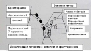 паховая ретенция яичек