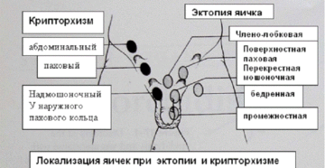 паховая ретенция яичек