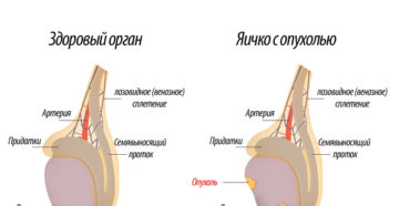 бугорок на яичке
