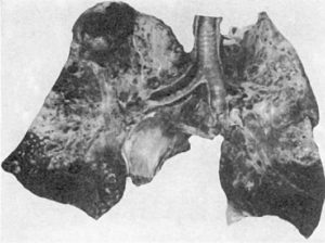 Bacillinum (Продукт мацерации туберкулезного легкого)