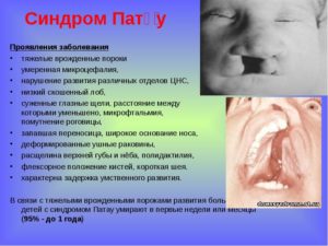 Симптомы болезни - хромосомные нарушения