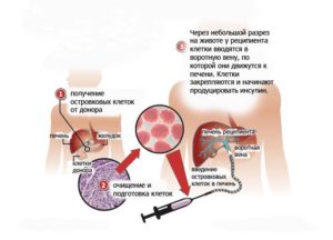 Трансплантация островковых клеток в качестве одного из способов лечения сахарного диабета