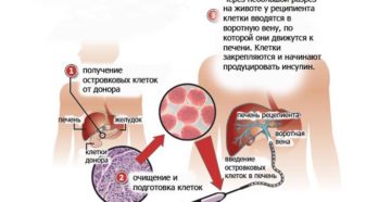 Трансплантация островковых клеток в качестве одного из способов лечения сахарного диабета