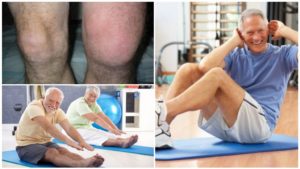 Ревматоидный артрит и упражнения