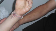 Перерезаны вены и сухожилия на руке