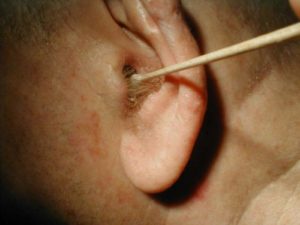 Болит ухо после высмаркивания