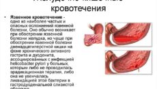 Желудочно-кишечные кровотечения