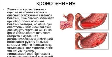 Желудочно-кишечные кровотечения