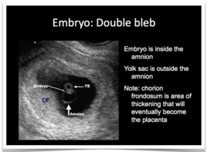 Эмбрион не лоцируется