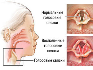 Ребенок сорвал голос