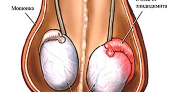 Симптомы болезни - боли в мошонке
