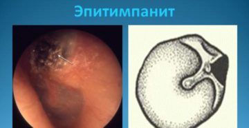 Хронический  гнойный эпитимпанит (продолжение...)