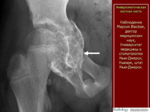 Остеобластакластома или Аневризмальная киста подвздошной кости
