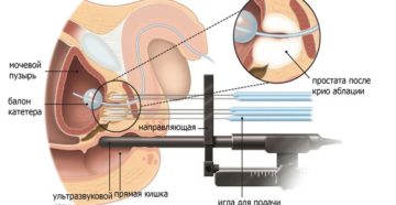 Криотерапия в лечении рака предстательной железы