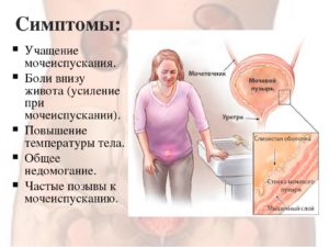 Симптомы болезни - боли после мочеиспускания