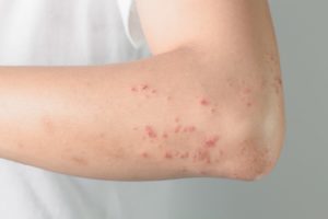 Аллергия на гепарин