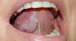 Симптомы болезни - боли во рту