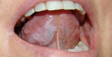 Симптомы болезни - боли во рту
