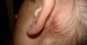 Шишка возле уха