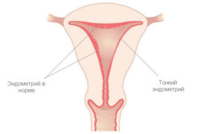 Тонкий эндометрий.