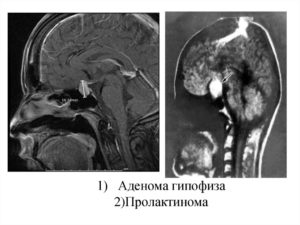 МРТ гипофиза при повышенном пролактине