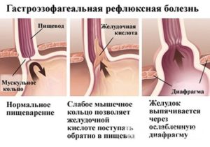 Гастроэзофагеальная рефлюксная болезнь (ГЭРБ)